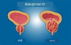 ต่อมลูกหมาก